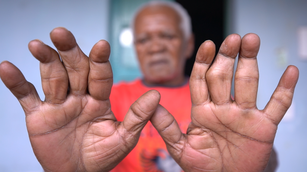 Tratamento correto impede sequelas em pacientes diagnosticados com  hanseníase - Cidades - Campo Grande News