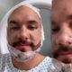 Eliezer fez transplantes de barba e cabelo em Fortaleza/CE
