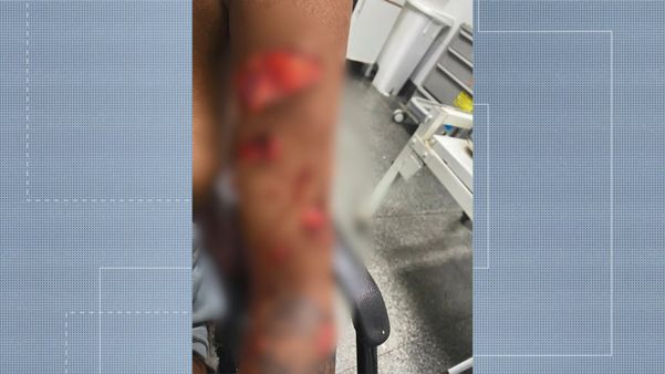 Adolescente grávida de 17 anos foi atacada por cachorros em Guarapari por Reprodução