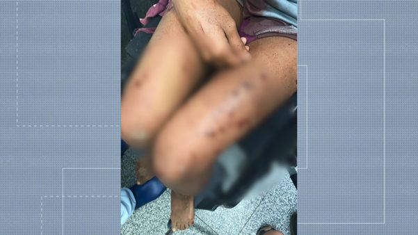 Adolescente grávida de 17 anos foi atacada por cachorros em Guarapari por Reprodução