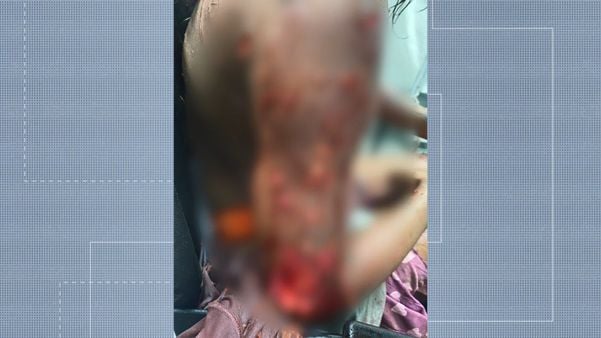 Adolescente grávida de 17 anos foi atacada por cachorros em Guarapari
