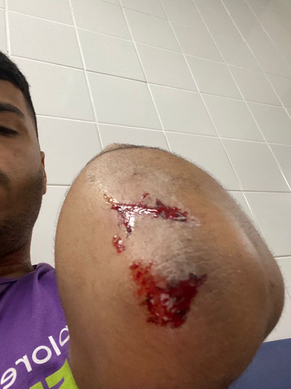 Motociclista sofre acidente e tem pescoço queimado ao ser atingido por fiação no ES por Paulo Vitor Machado