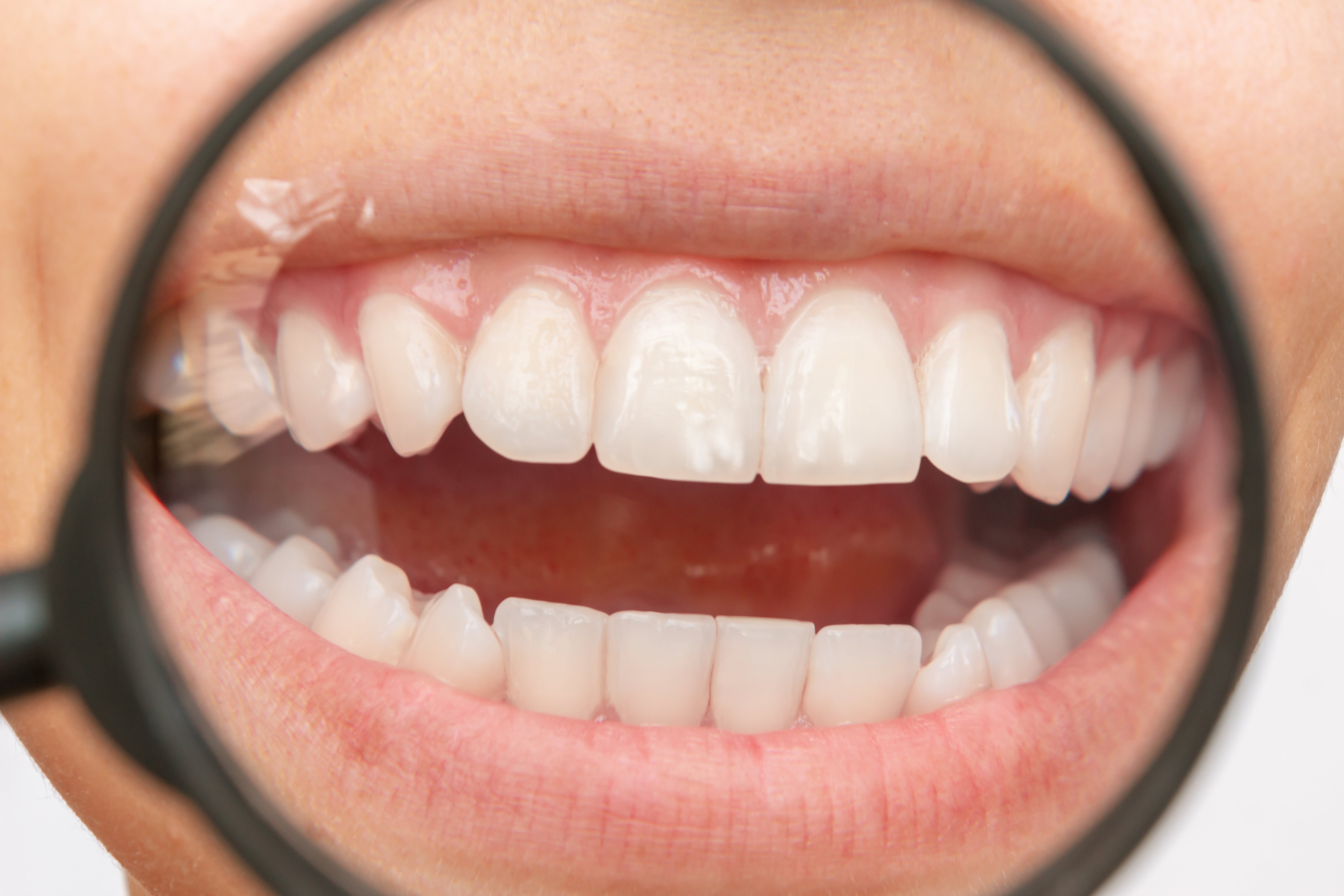 Dentistas explicam que o procedimento não é invasivo e, nem sempre, há necessidade de desgaste dos dentes