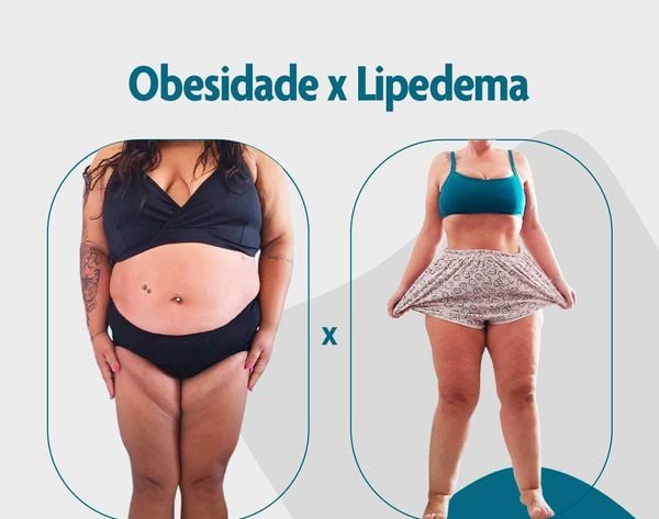 https://midias.agazeta.com.br/2022/09/27/lipedema-doenca-confundida-com-obesidade-842832-article.jpeg