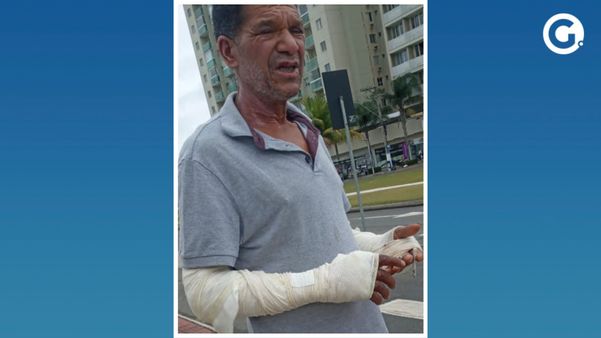 Valmir José da Costa, de 57 anos, estava perto do carrinho quando a botija de gás explodiu. Ele passou 13 dias internados. 