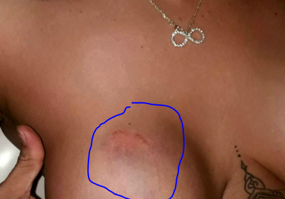 Seio da vítima foi mordido por jogador do Botafogo-SP quando ela negou as relações sexuais