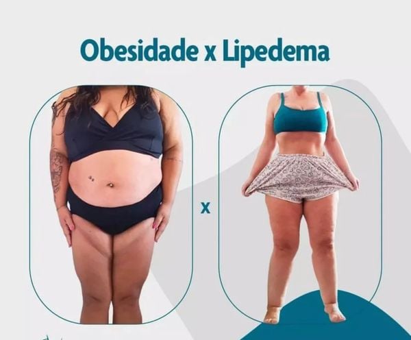 Diferenças no corpo causadas pela obesidade e pelo lipedema