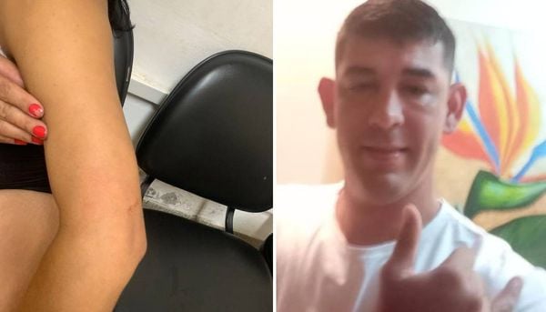 Mulher mostra marca no braço após briga com Fabio Junior Chaves. que foi morto após agredir a esposa