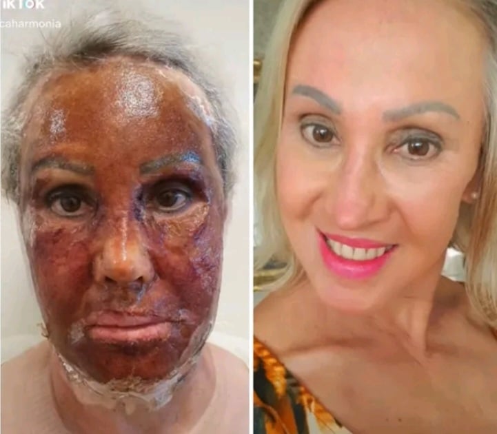 Procedimento que viralizou após transformação de paciente de Caxias, mostra o rosto da mulher passando pelas etapas de recuperação. Dermatologistas explicam que o procedimento pode afetar o coração