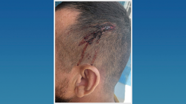 Foto mostra como ficou a cabeça do gesseiro após a coronhada dada pelo criminoso, em Jardim Atlântica, na Serra