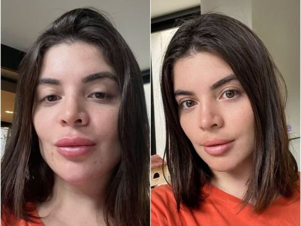 Gkay publicou no Instagram uma série de stories mostrando como ficou seu rosto após fazer procedimento para retirar o preenchimento labial