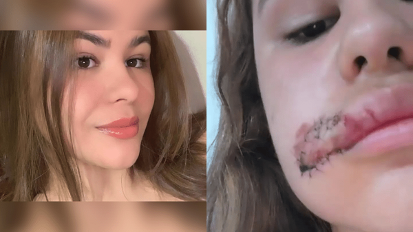 Alyna tem 18 anos e levou 14 pontos no rosto durante uma tentativa de assalto em Maceió (AL)