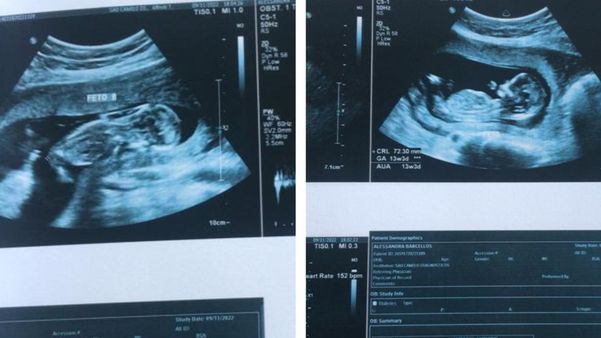 Família pede ajuda para pagar cirurgia de grávida de gêmeas em Aracruz