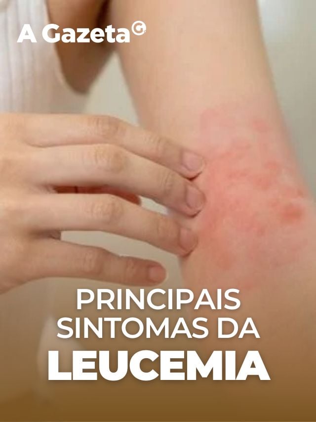 sintomas de leucemia