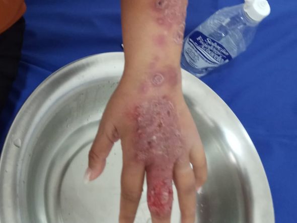 Esporotricose: casos de doença sobem em Linhares por Divulgação/Prefeitura de Linhares