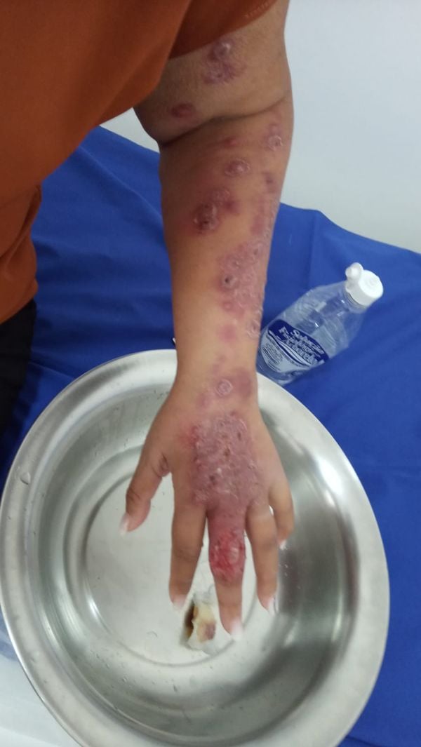 Esporotricose: casos de doença sobem em Linhares por Divulgação/Prefeitura de Linhares