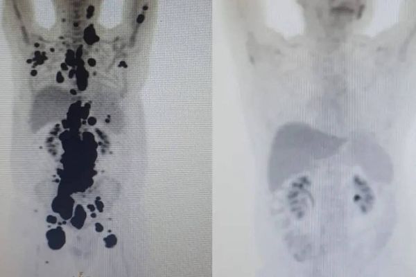 Exames mostram antes e depois de câncer de paciente; à direita, imagem mostra remissão da doença