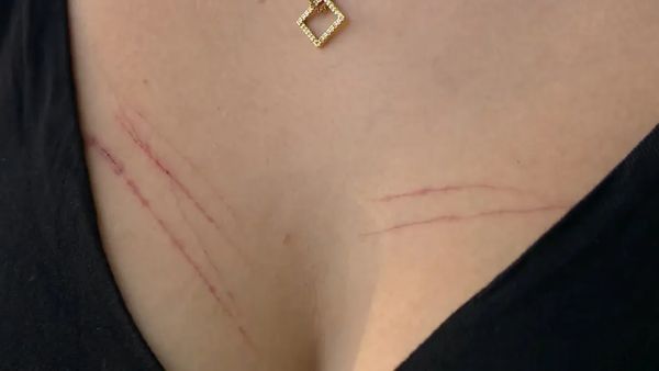 Marcas de agressões em universitária de 20 anos agredida pelo namorado em Vitória