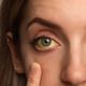 hepatites virais: olhos amarelados