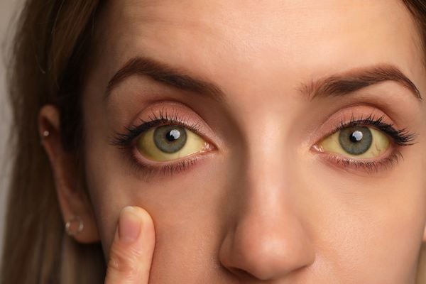 hepatites virais: olhos amarelados