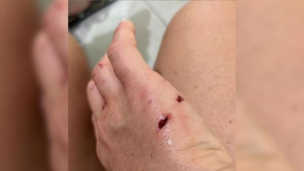 Designer foi mordida ao tentar salvar sua cachorra de ataque 