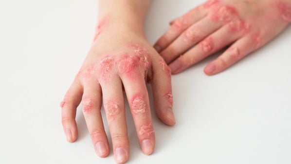 A campanha Junho Laranja 2025 tem por objetivos sensibilizar profissionais de saúde, a comunidade e as vítimas sobre a importância da notificação/denúncia dos casos de violência por queimaduras