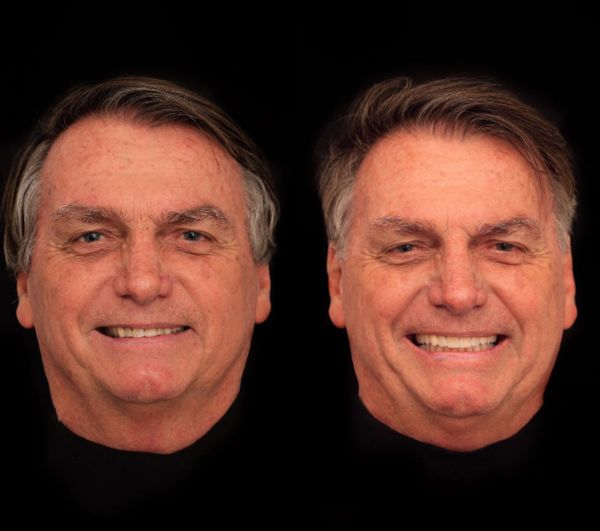 O ex-presidente Jair Bolsonaro fez harmonização dentária
