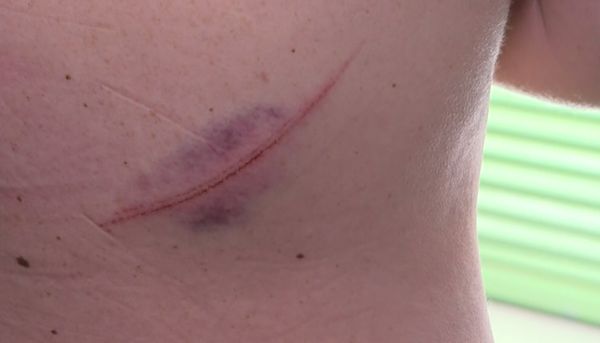 Um dos ferimentos de esposa agredida pelo marido com golpes de karatê