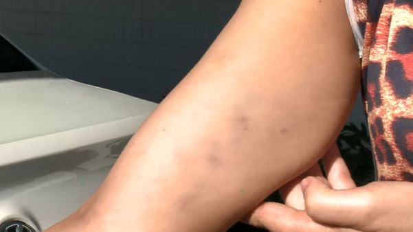 Dona de casa mostra marcas de agressão após confusão com namorado