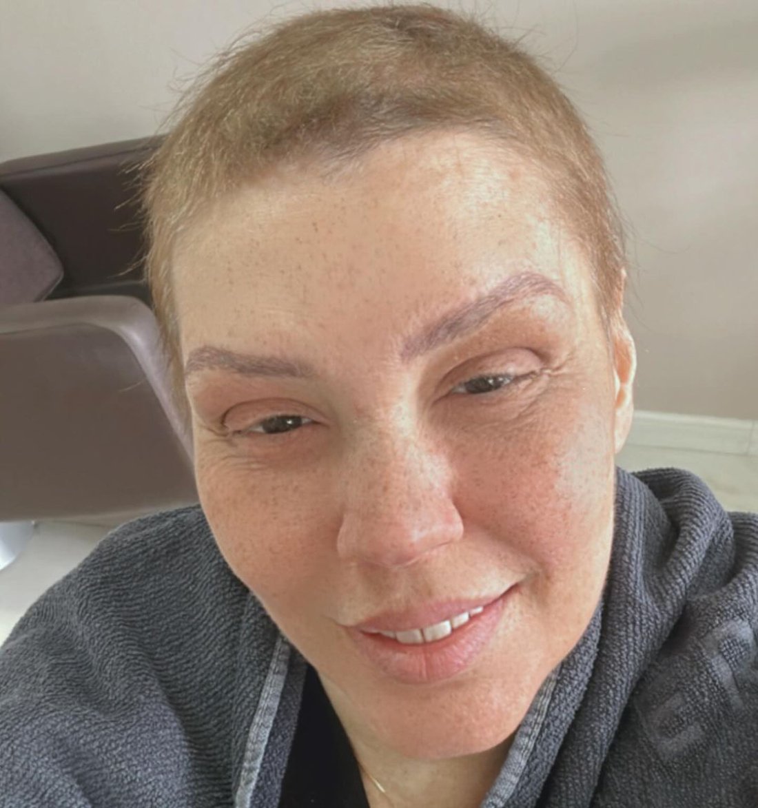 Com a doença em fase de remissão, a cantora postou fotos sem a prótese capilar que costuma usar