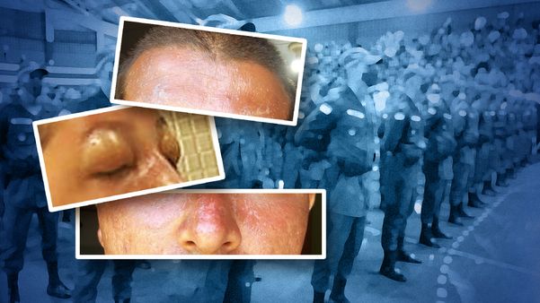 Além dos sintomas de insolação, há relatos de queimadura de primeiro grau após curso da PM