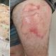 Imagem - Celular explode no bolso de calça e homem sofre queimadura na perna no ES