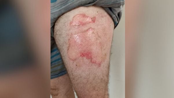 Fotos da queimadura da perna da vítima após explosão do celular em seu bolso