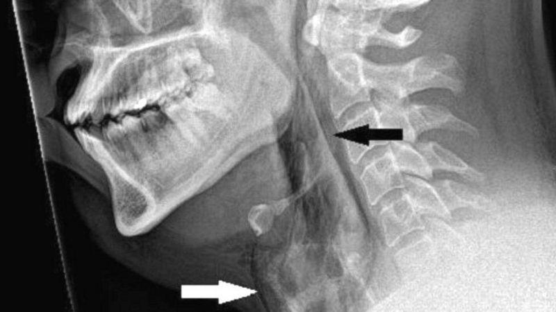 Um paciente teve ruptura na traqueia após fechar a boca e o nariz ao mesmo tempo, mas há como evitar espirros sem riscos
