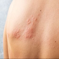 De acordo com relatório divulgado pela Comissão Nacional de Incorporação de Tecnologias no Sistema Único de Saúde (Conitec), disponível online, a vacina foi considerada cara diante do impacto que poderia ter em relação ao combate a doença