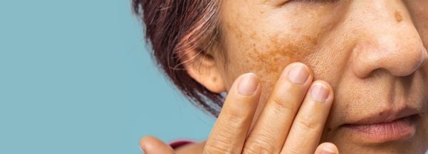 Melasma é uma das doenças mais comuns do Verão