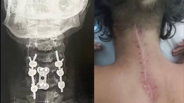 Lindalva fraturou as vértebras C5 e C6 e realizou uma cirurgia para fusão das vértebras e colocação de parafusos