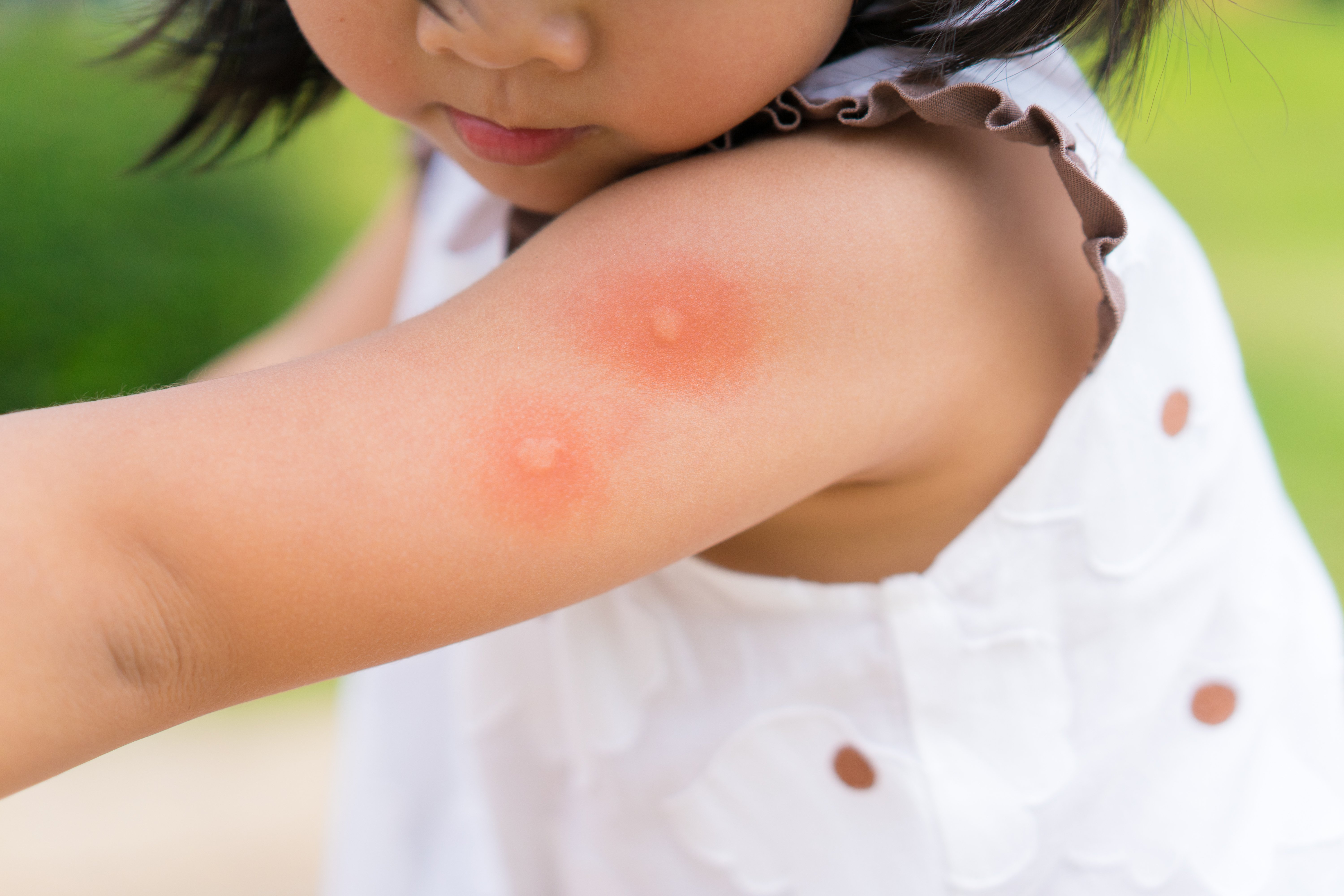 Pediatra explica como proteger os pequenos que estão mais suscetíveis a complicações causadas por essa doença