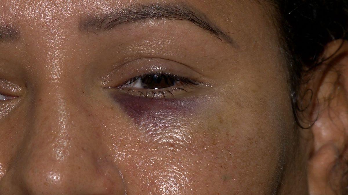 Mulher ficou com ferimentos no rosto e na cabeça após ser arremessada de carro