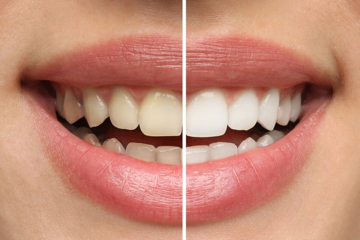 Dentista explica como procedimento sem supervisão profissional pode prejudicar os dentes