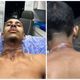 Imagem - Motoboy sofre queimaduras no pescoço após se enrolar em fios soltos em Cariacica