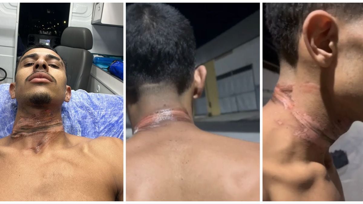 O motobou Artur Rios, de 22 anos, voltava de uma entrega quando um fio de posto que estava baixo acabou deixando o pescoço dele queimado.