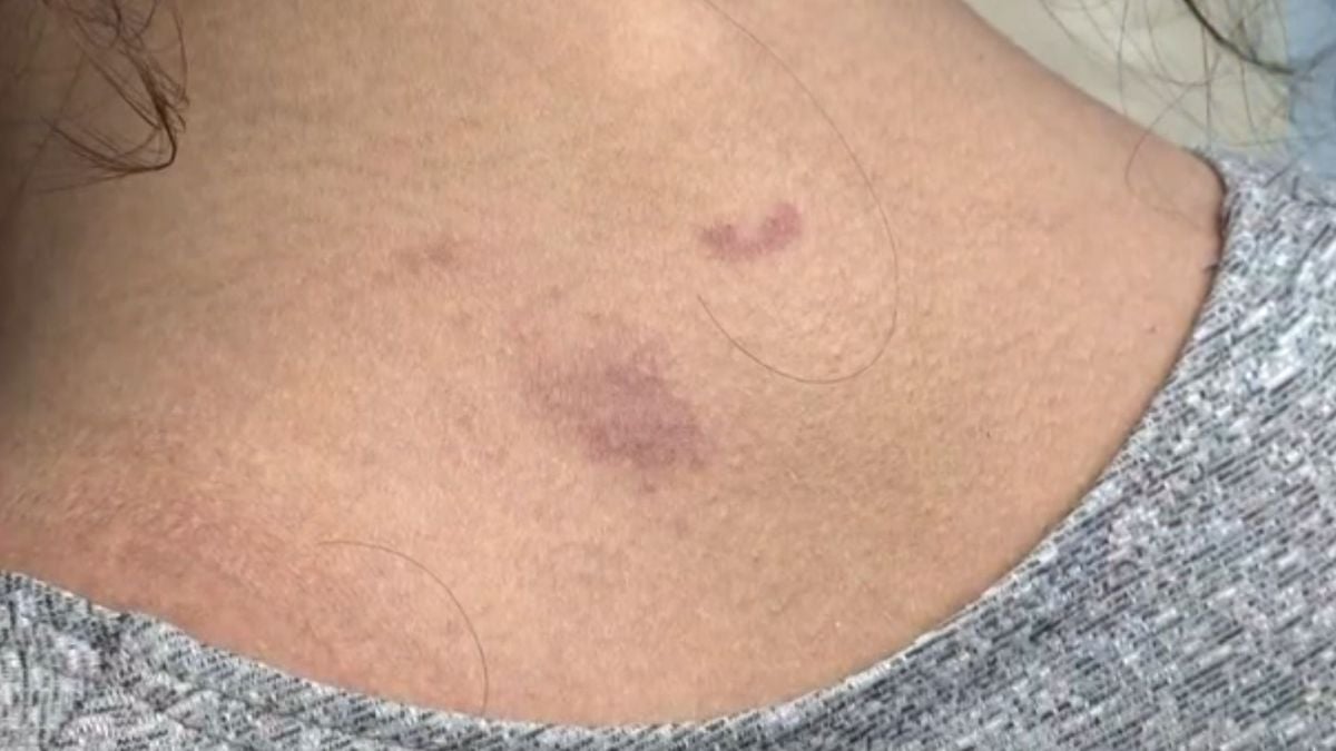 Moradora da Serra é agredida pelo marido e fica com marcas pelo corpo