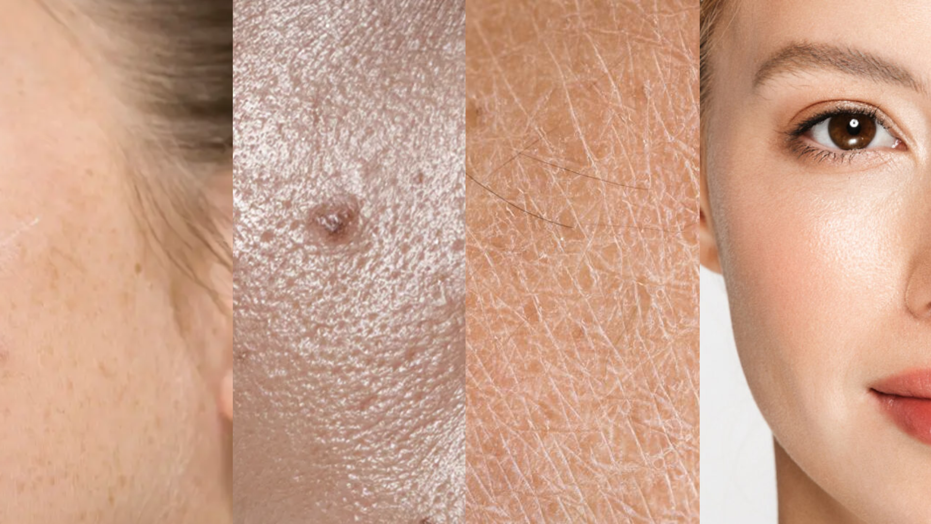 Da esquerda para a direita: imagens ilustrativas de pele mista, oleosa, seca em processo de descamação e normal. Crédito: Divulgação