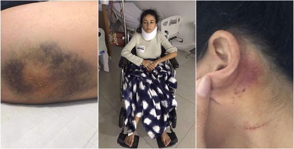 Além da bacia quebrada, Mônica ficou com hematomas na perna e na cabeça