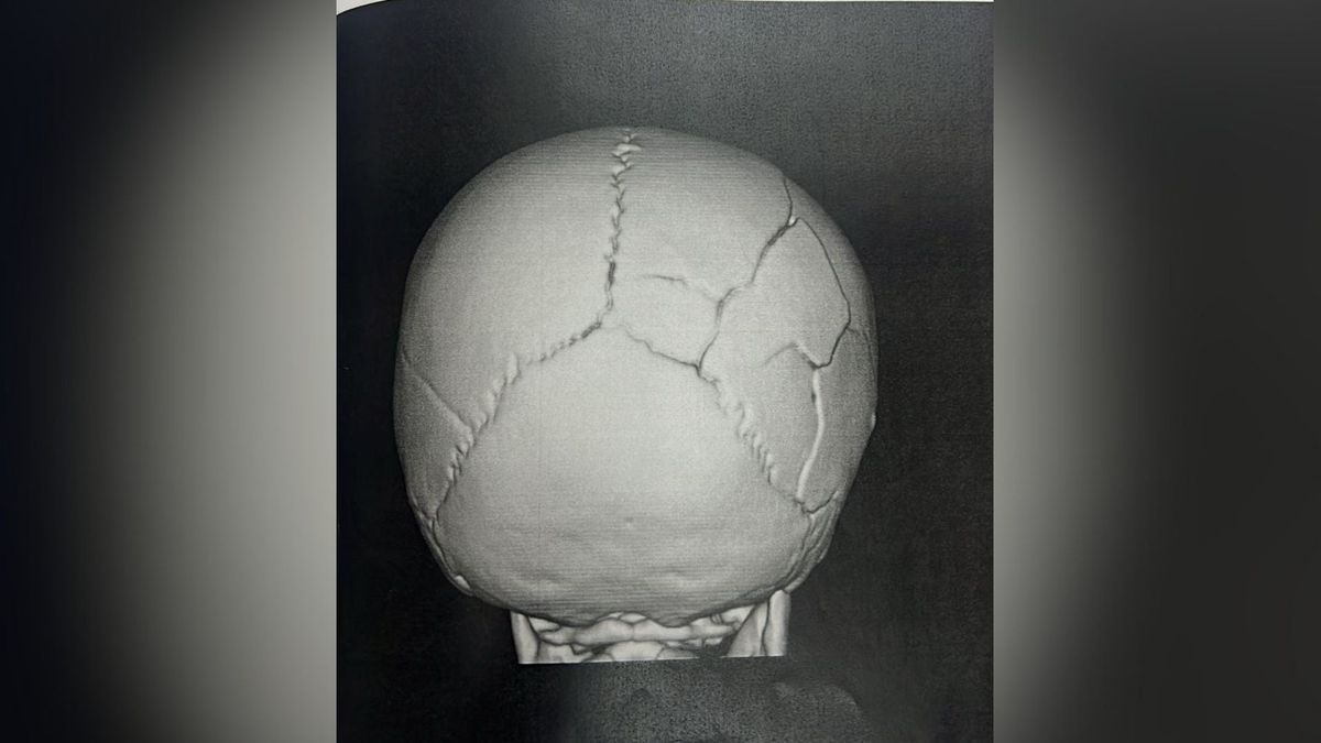 Tomografia da cabeça de bebê agredida na Serra