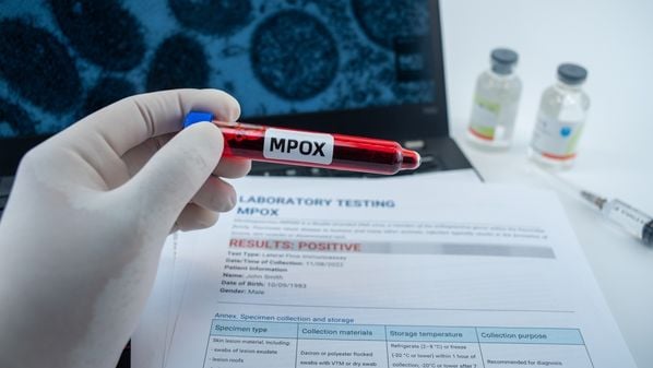 Paciente é um homem de 30 a 39 anos; Estado ainda investiga dois casos suspeitos e descartou outros 42 registros