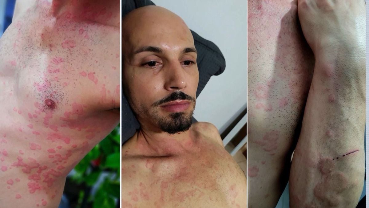 Saulo Júnior Lima foi diagnosticado com urticária crônica espontânea