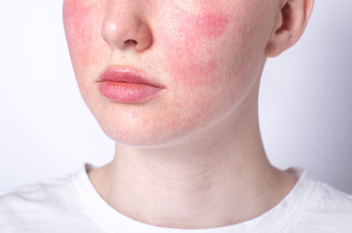 Rosacea