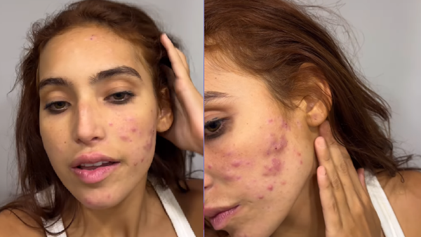 Vanessa Lopes teve crise de acne